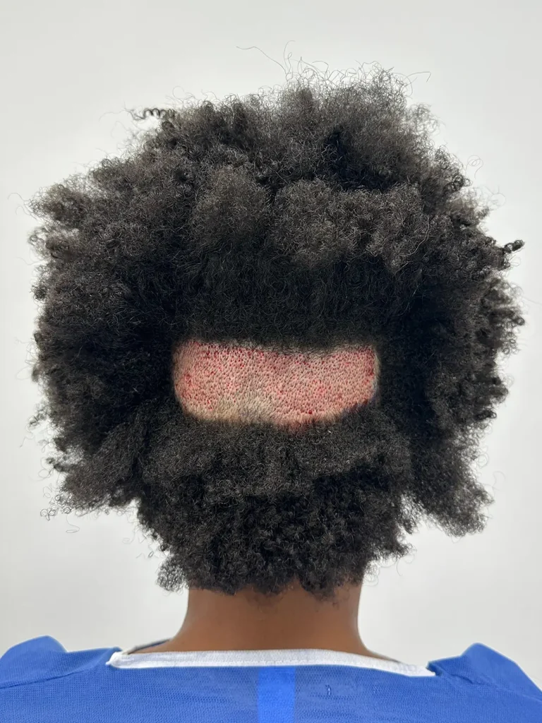 Injerto capilar en pelo afro. InhairClinic Oviedo