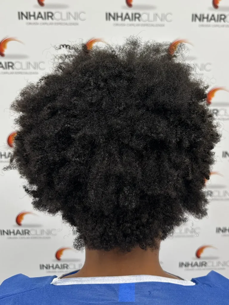 Injerto capilar en pelo afro. InhairClinic Oviedo