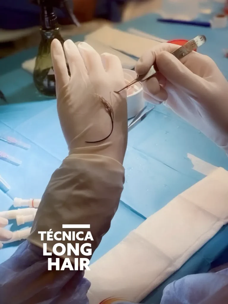 Long hair: injerto capilar sin rapar